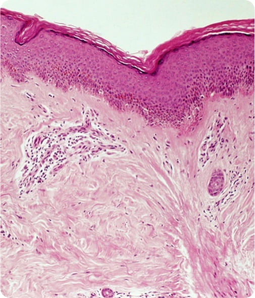 systemic-sclerosis